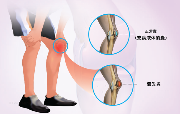 关节炎