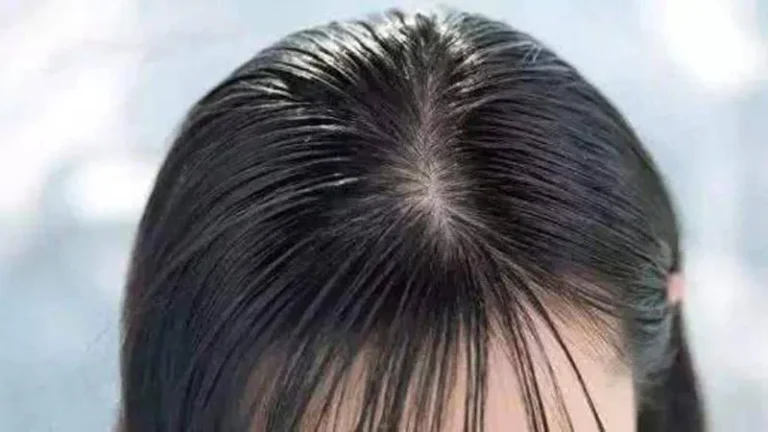 【实测爆火攻略】他们这样护理头皮，从“炸毛油头”逆袭成发量担当！